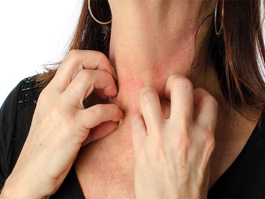 Natural Ways To Soothe Eczema