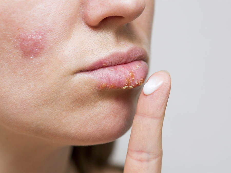 11 Ways How to Avoid Cold Sores This Winter